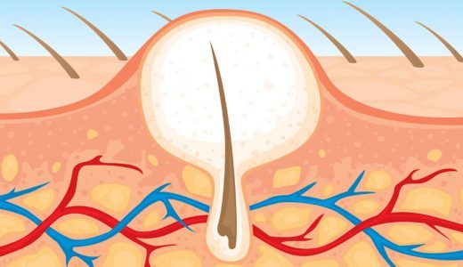 Ways to remove and prevent the ingrown hair