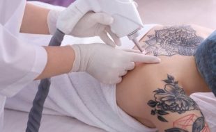 How the laser hair removal affects your tattoos?
